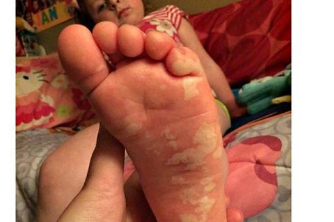 Jana Syfert burned her left foot after stepping on smoldering residue from a bonfire someone left covered with sand. Jana Syfert burned her left foot after stepping on smoldering residue from a bonfire someone left covered with sand.